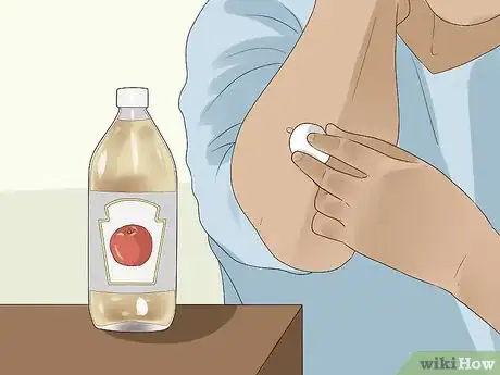 Image titled Get Rid of Skin Tags Step 13