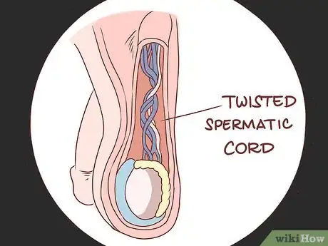 Image titled Treat Pain and Swelling in the Testicles Step 13