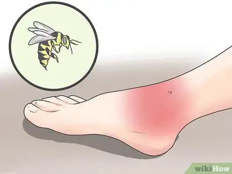Image titled Spot Distributive Shock Symptoms Step 9