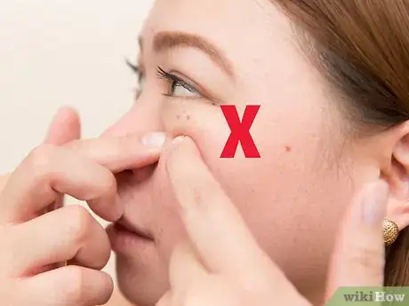 Image titled Get Rid of Acne Using Mint Leaves Step 17