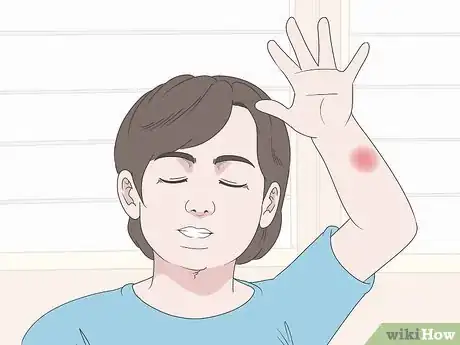 Image titled Treat Spider Bites on Kids Step 7