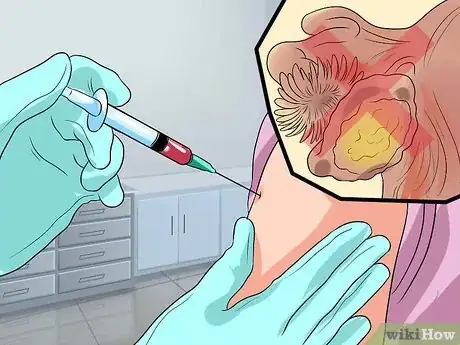 Image titled Reduce HPV Related Cancer Risks Step 12