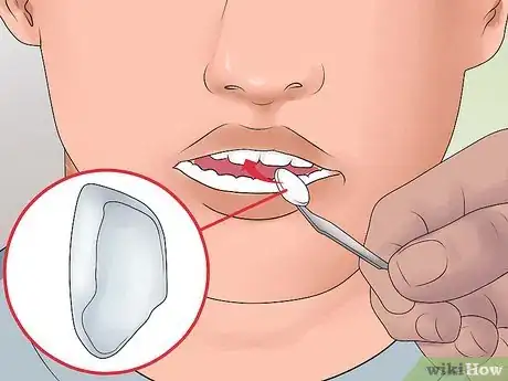 Image titled Avoid Getting Braces Step 6