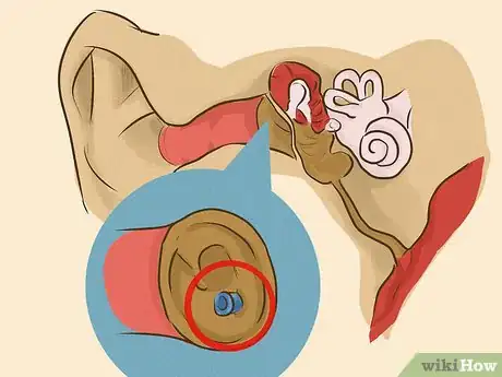 Image titled Drain Ear Fluid Step 17