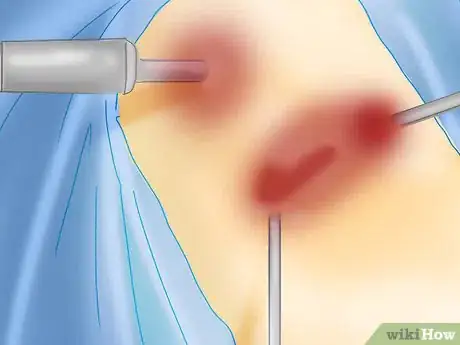 Image titled Prevent Kidney Stones from Recurring Step 13