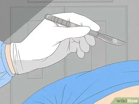 Image titled Treat Inguinal Hernia Step 10