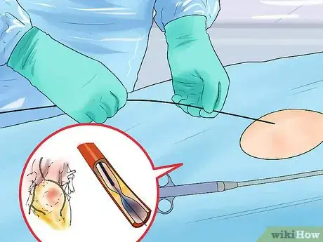 Image titled Diagnose Aortic Regurgitation Step 11