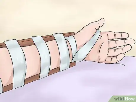 Image titled Reduce Symptoms of Carpal Tunnel During Pregnancy Step 2