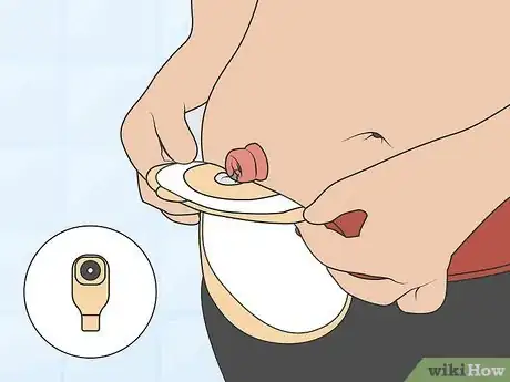 Image titled Get Used to an Ostomy Step 12