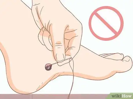 Image titled Treat a Blood Blister Step 3