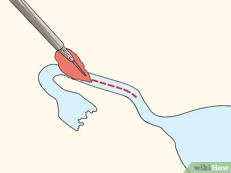 Image titled Have Essure Sterilization Reversed Step 6