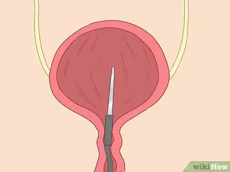 Image titled Cure Bladder Pain Step 20