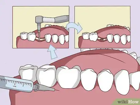 Image titled Replace a Tooth Step 11