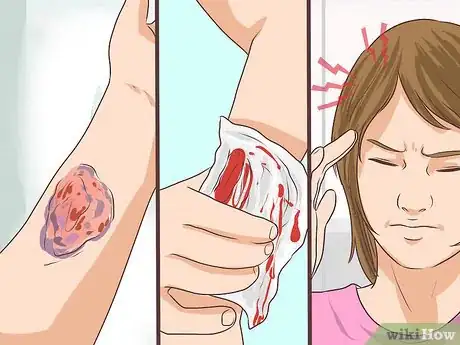 Image titled Take Lifestyle Precautions for Hemophilia Step 10