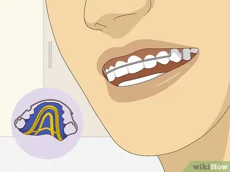 Image titled Wear Braces With Confidence and Style Step 3