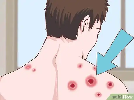 Image titled Treat Fibromyalgia with Acupuncture Step 3