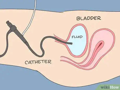 Image titled Cure Bladder Pain Step 19