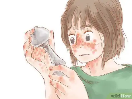 Image titled Treat Lupus Step 14