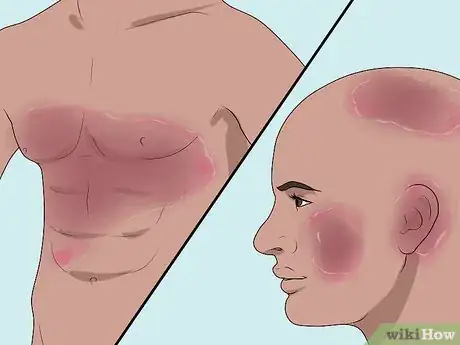 Image titled Diagnose Erythrodermic Psoriasis Step 9