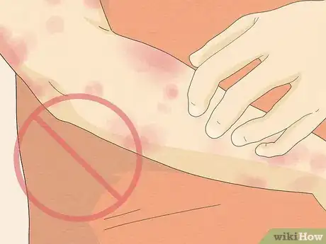 Image titled Recognize Hives (Rash) Step 14