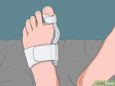 Image titled Treat Bunions Naturally Step 5