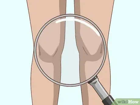 Image titled Deal With Osgood Schlatter Disease Step 4