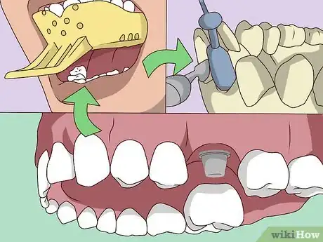 Image titled Replace a Tooth Step 14