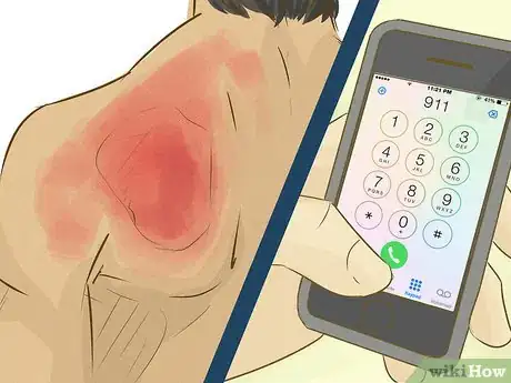 Image titled Treat a Sunburn Step 4