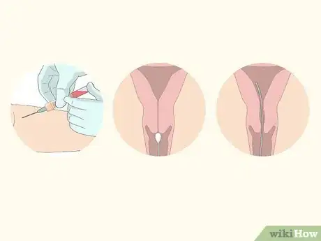 Image titled Treat Menorrhagia Step 14