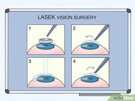 Image titled Know if Laser Vision Surgery Is Right for You Step 9