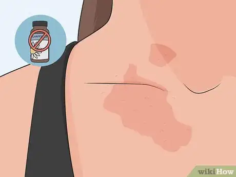 Image titled Use Chamomile As a Fungal Treatment Step 7