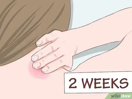 Image titled Use Cayenne for Back Pain Step 9