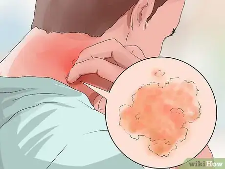 Image titled Reduce Eczema Itching Step 18