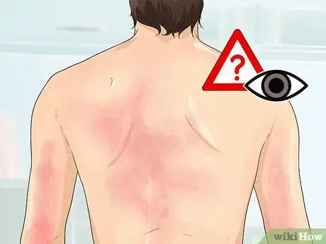 Image titled Treat Erythrodermic Psoriasis Step 10