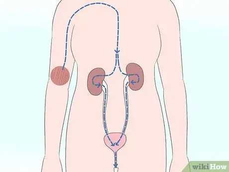 Image titled Bring Down High Creatinine Levels Step 1