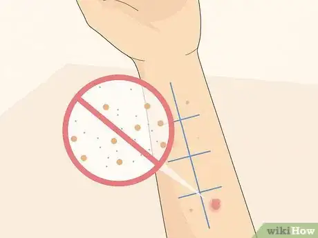 Image titled Patch Test Skin Step 9