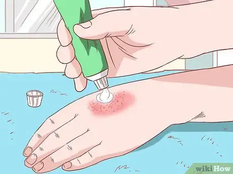 Image titled Handle an Eczema Flare Up Step 23