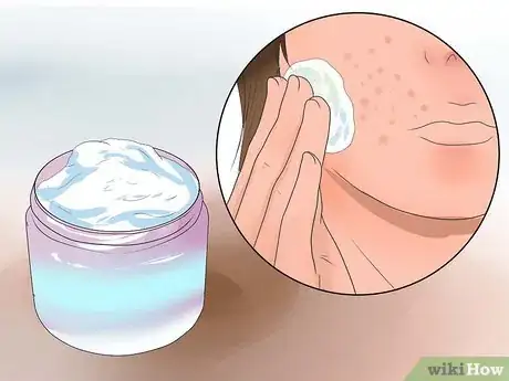 Image titled Deal With Acne when You Have Sensitive Skin Step 6