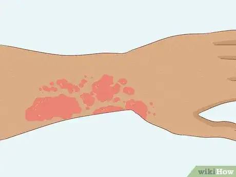 Image titled What Are the Health Benefits of Fenugreek Step 8