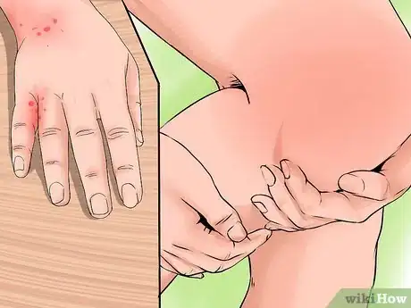 Image titled Diagnose and Treat Scarlet Fever Step 11