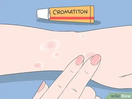 Image titled Stop Scabies Itching Step 10