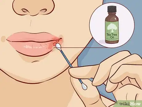 Image titled Treat Skin Conditions with Tea Tree Oil Step 7