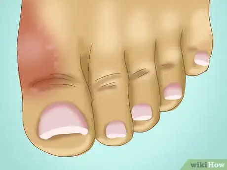Image titled Relieve a Sore Damaged Toe Step 1