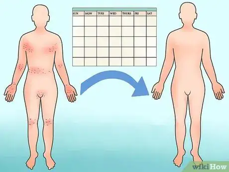 Image titled Recognize Scabies Rash Step 16
