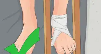 Make a Traction Splint for a Fractured Femur