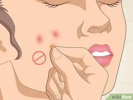 Image titled Reduce Scars Naturally Step 10