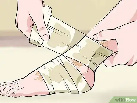 Image titled Reduce Scarring from Eczema Step 13