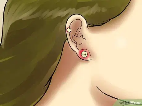 Image titled Care for an Auricle Piercing Step 8