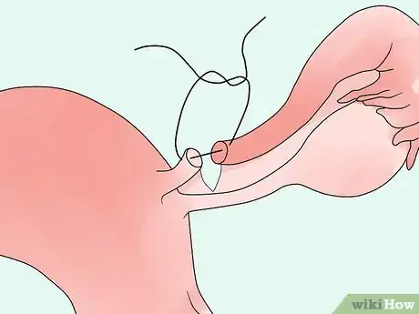 Image titled Have Essure Sterilization Reversed Step 8