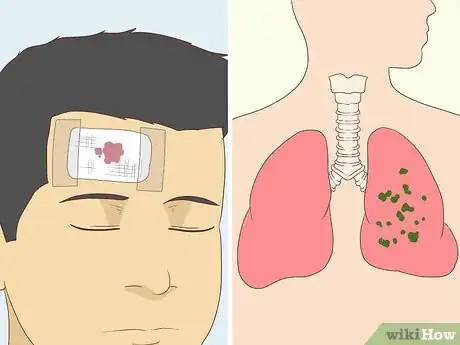 Image titled Treat Neurological Disorders Step 3